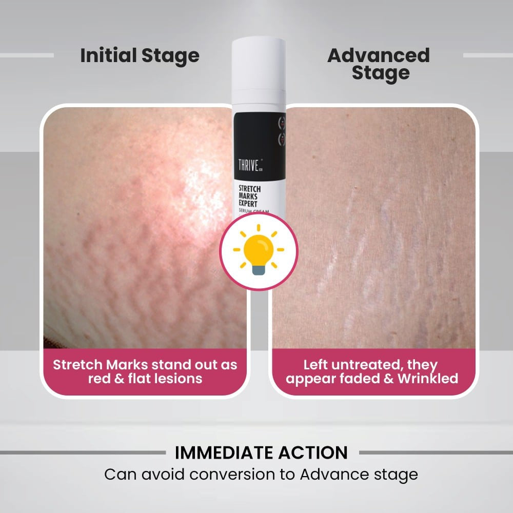 ThriveCo Stretch Marks Expert Skin Serum : 30 ml