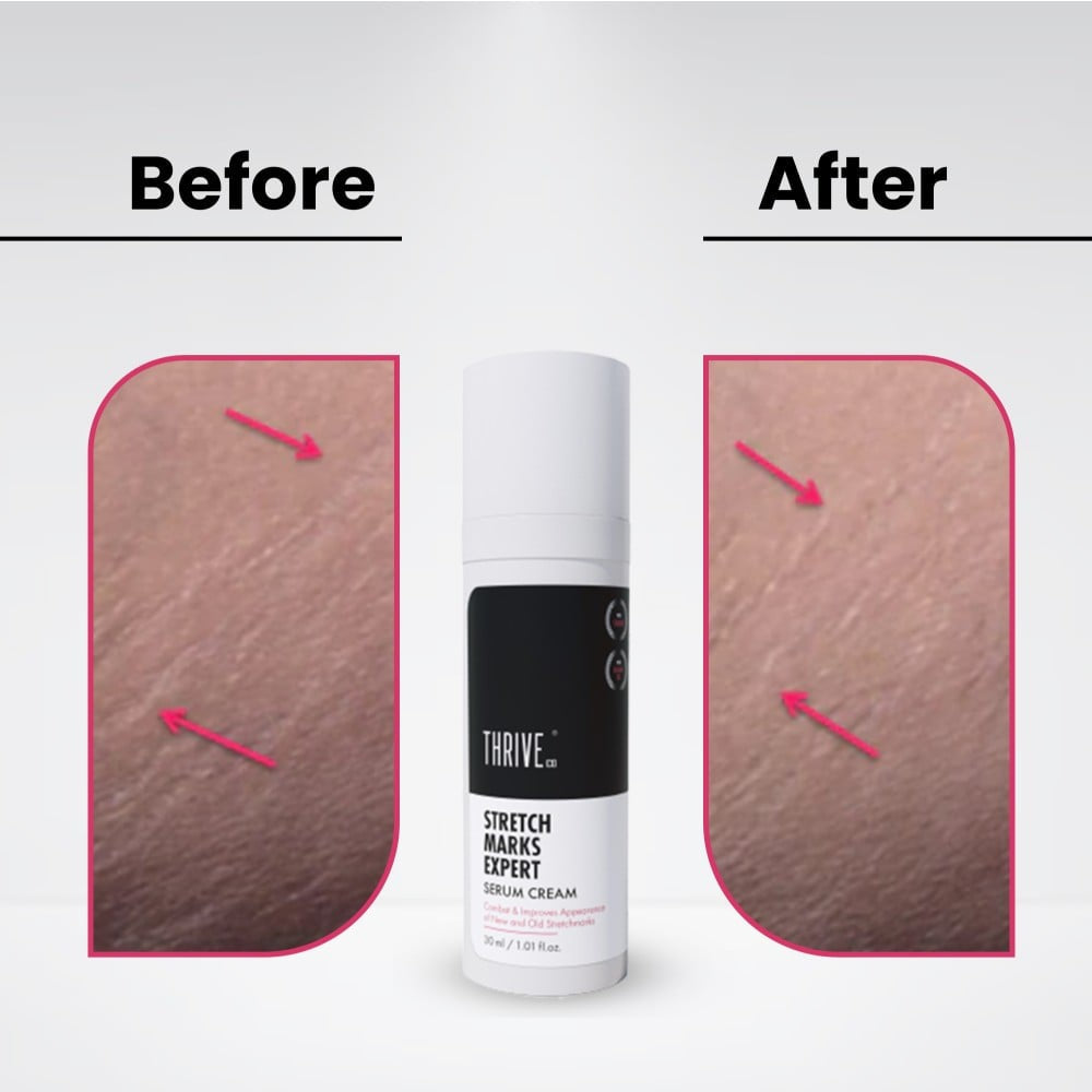 ThriveCo Stretch Marks Expert Skin Serum : 30 ml