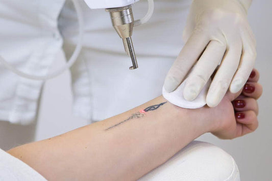 Tattoo Removal Services