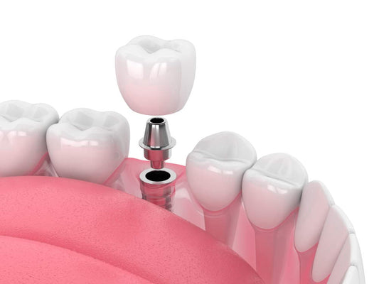 Doctors For Dental Implantation